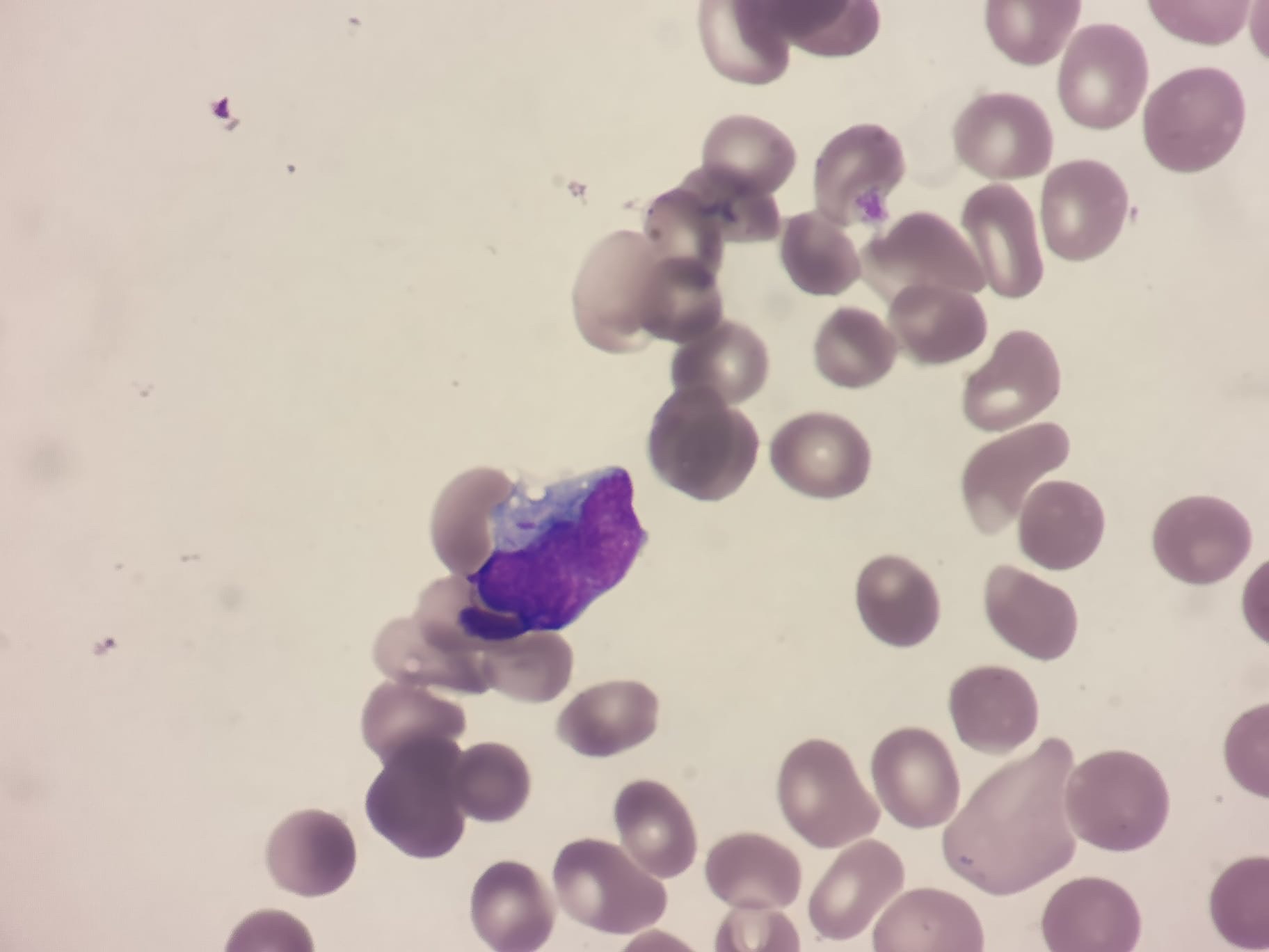 Acute vs Chronic Leukaemia – A Brief Overview